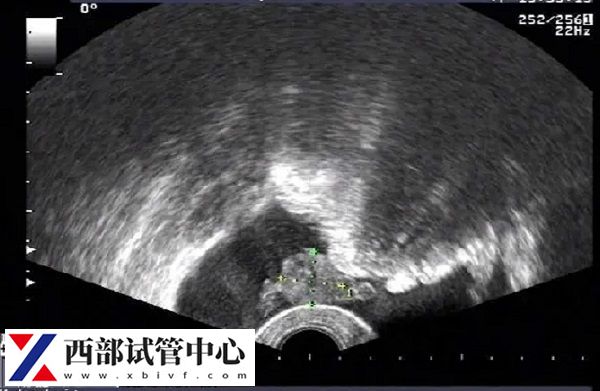 囊胚移植一超沒(méi)有卵黃囊二超可能會(huì)有