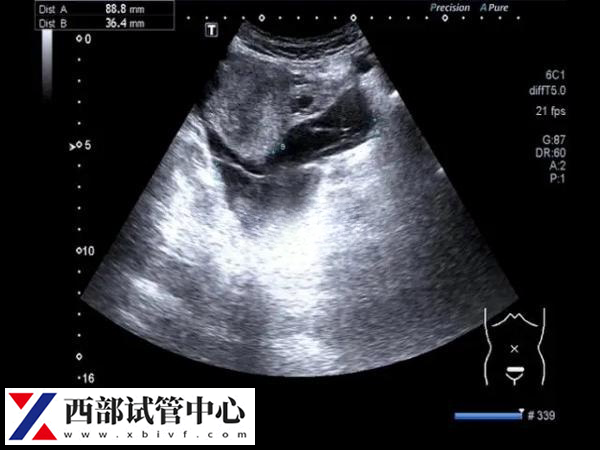 卵黃囊通常在懷孕的第5到第10周之間可見(jiàn)